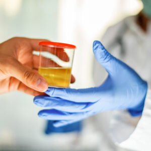 Uric Acid Test